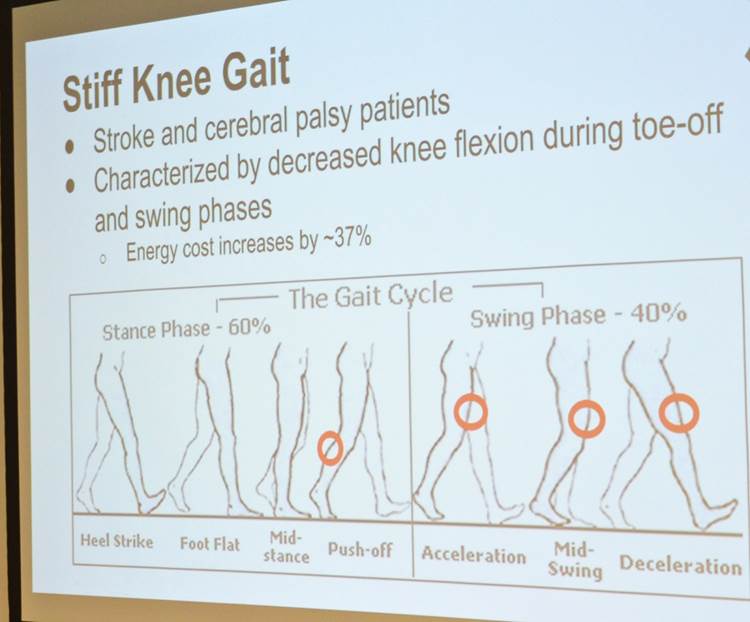 Description of stiff knee gait, a condition that may happen after a stroke